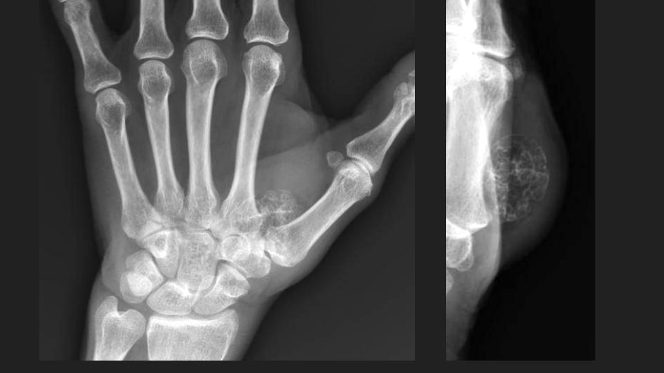Figure 5 for case chondroma ( RID4126 )